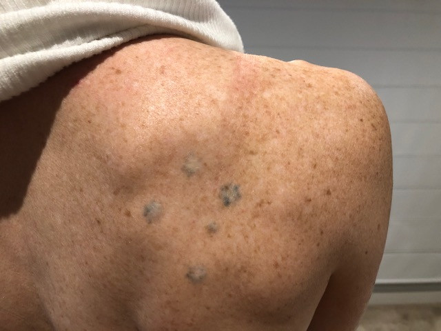 A southern cross tattoo on a shoulder