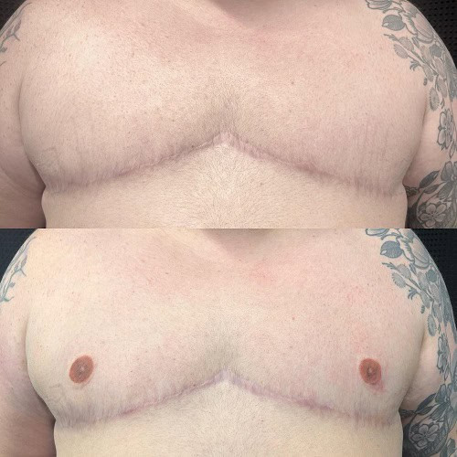 3D nipple tattoo on chest, demonstrating realistic skin texture and depth after mastectomy.