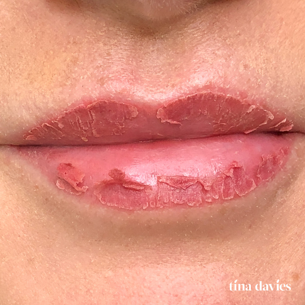 Day 4 of Lip Blush Tattoo Healing Process with Significant Peeling