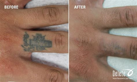 Laser tattoo removal process on a hand