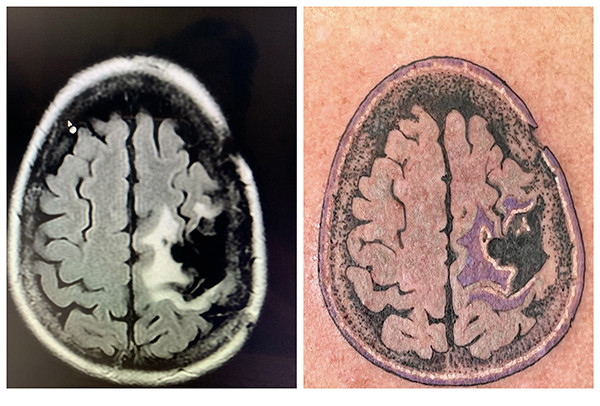 Tattoo of Heather O.'s brain MRI scan with purple accents on her shoulder, representing her invisible deficits and resilience.