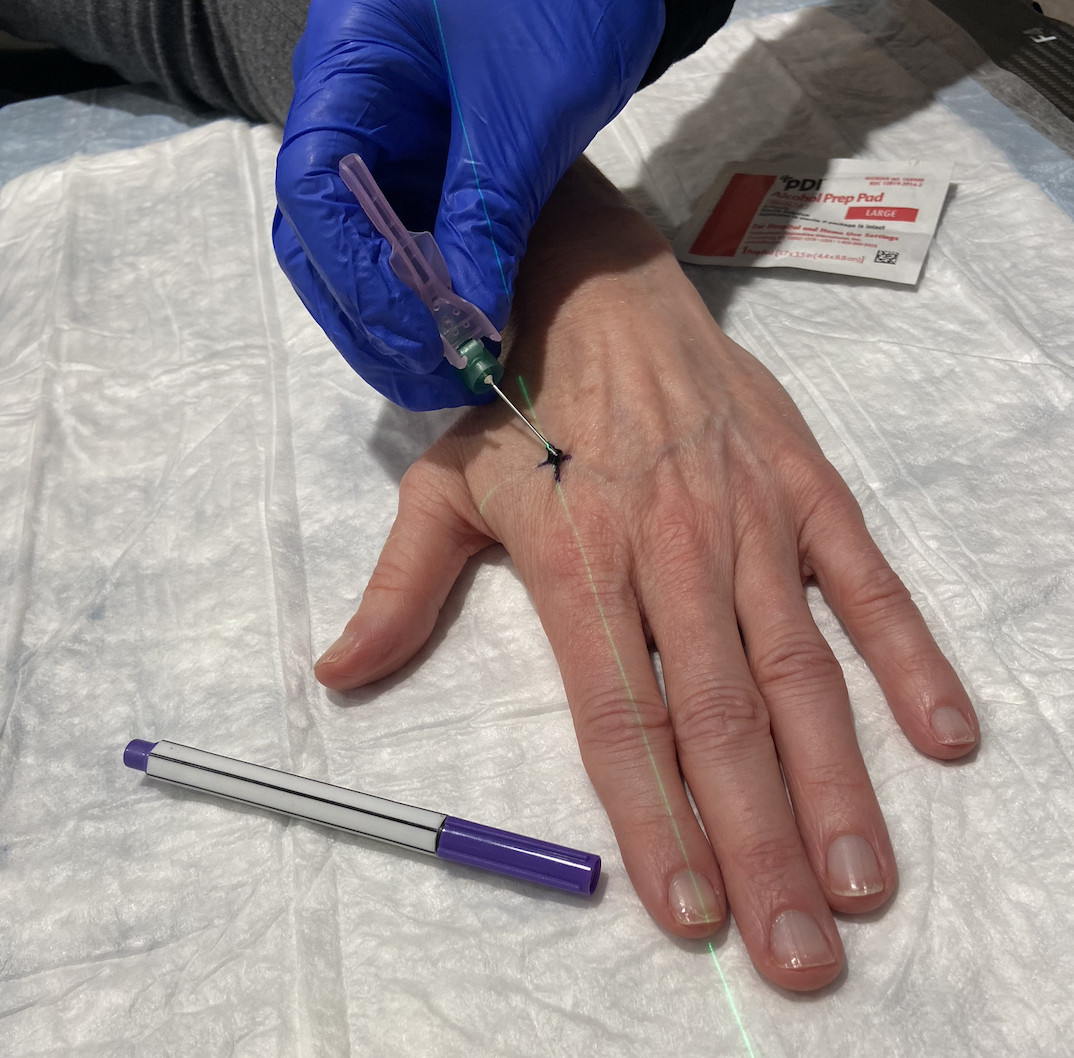 Close-up view of the needle gently pricking the skin to deposit ink for a radiation therapy tattoo, showing how the mark is created in the skin's upper layers.