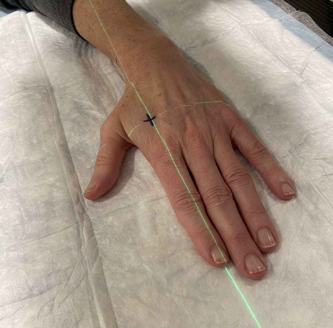 Laser beams marking the treatment area on a patient's skin during radiation therapy simulation, a step that sometimes involves getting small medical tattoos.