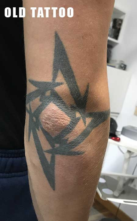 vecchio tatuaggio su gomito con logo del gruppo musicale Metallica, da coprire.