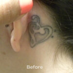 Before & After Tattoo Removal Patient 4536 - Initial Tattoo