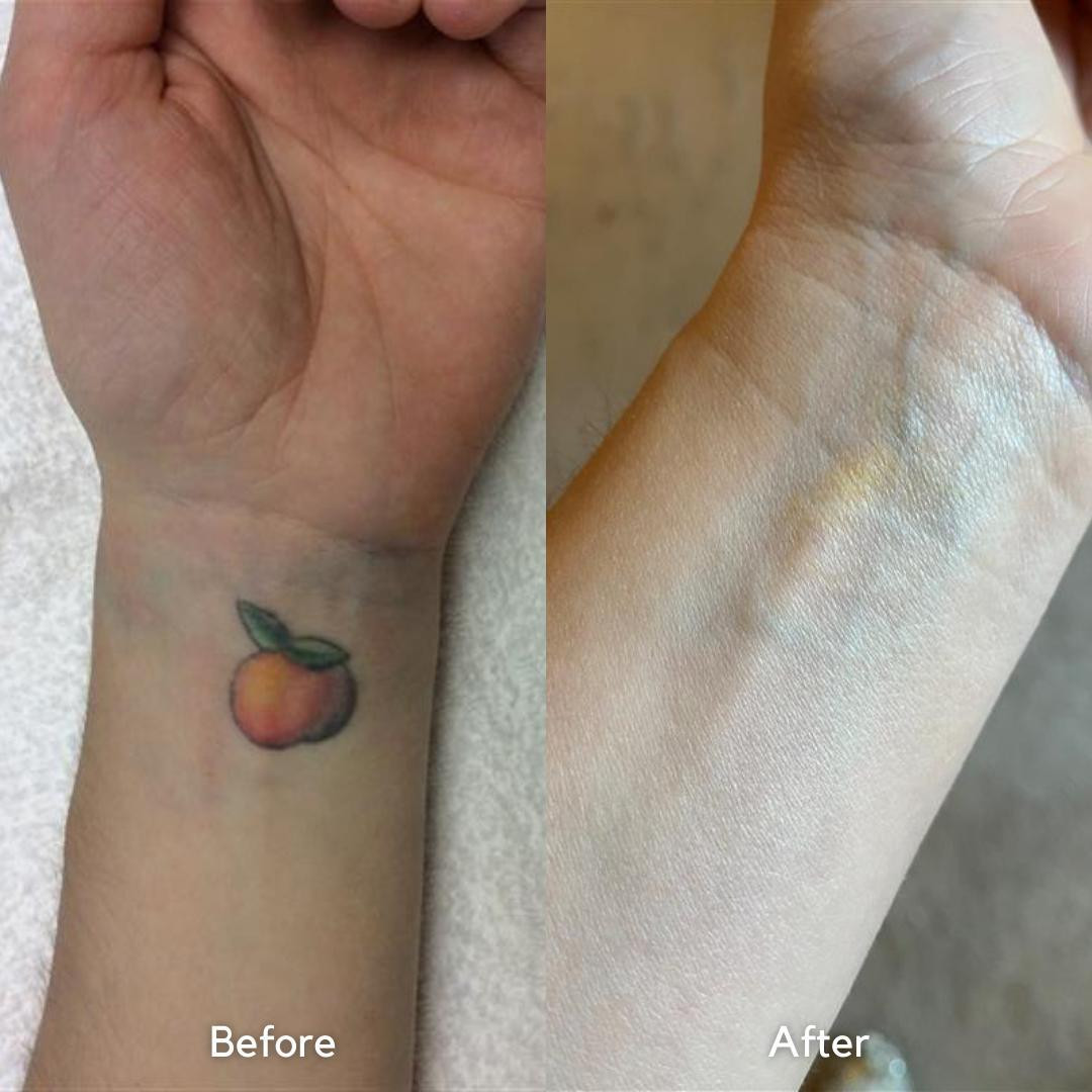 tattoo removal before and after