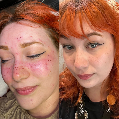 Fresh vs healed freckle tattoos close up