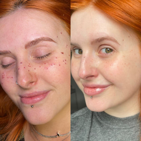 Fresh and healed freckle tattoos