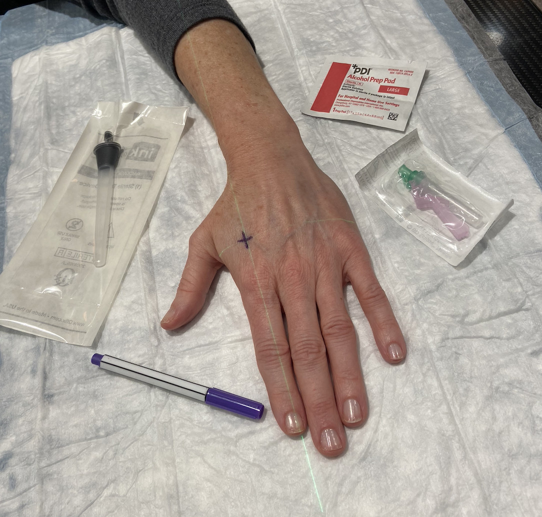 Supplies used for radiation therapy tattoos, including alcohol wipes for cleaning the skin before the procedure, ensuring a sterile environment.