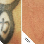 Tattoo Removal Before and After - 01