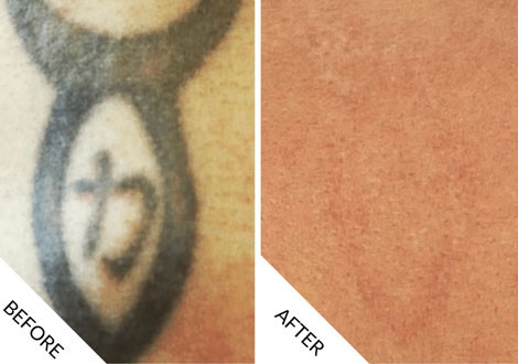 Tattoo Removal Before and After - 01