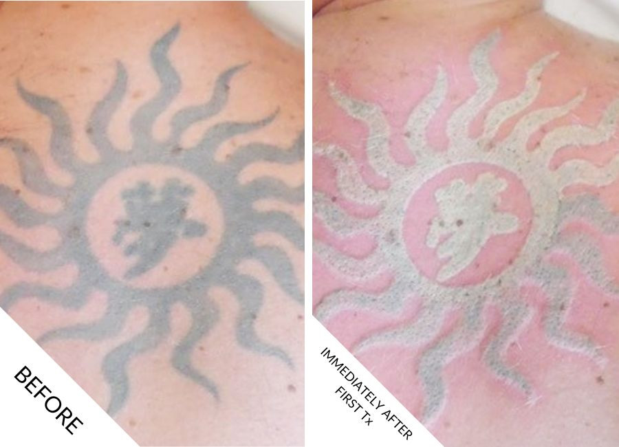 Tattoo Removal Before and After - 02