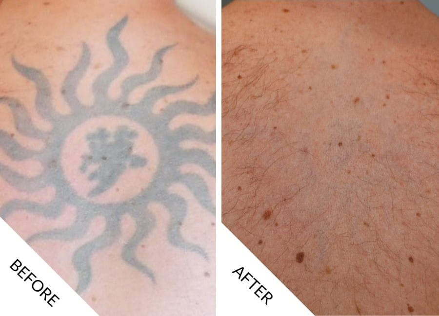 Tattoo Removal Before and After - 03