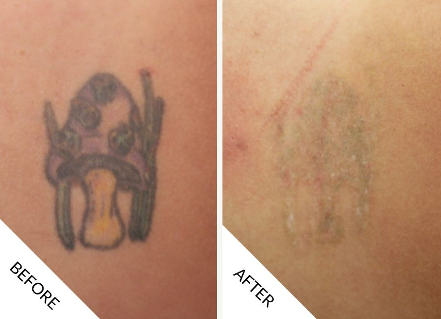 Tattoo Removal Before and After - 04