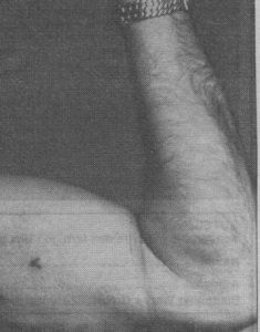 Example of an SS blood group tattoo