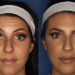 Botox before and after example showcasing smooth skin
