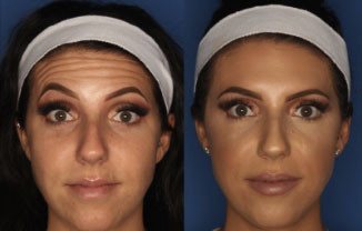 Botox before and after example showcasing smooth skin