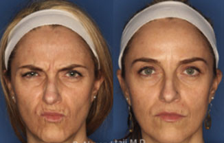 Botox after shot depicting smooth skin and relaxed facial muscles