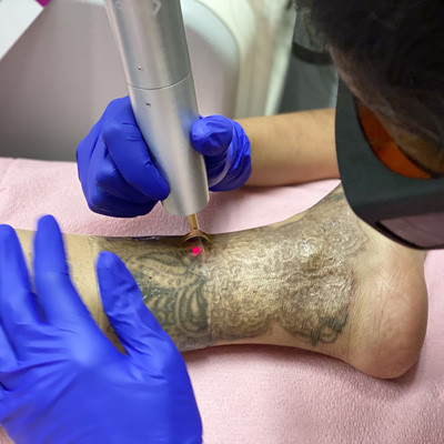 Laser tattoo removal process