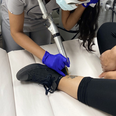 Redness after laser tattoo removal