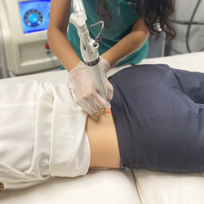 Tattoo removal costs comparison