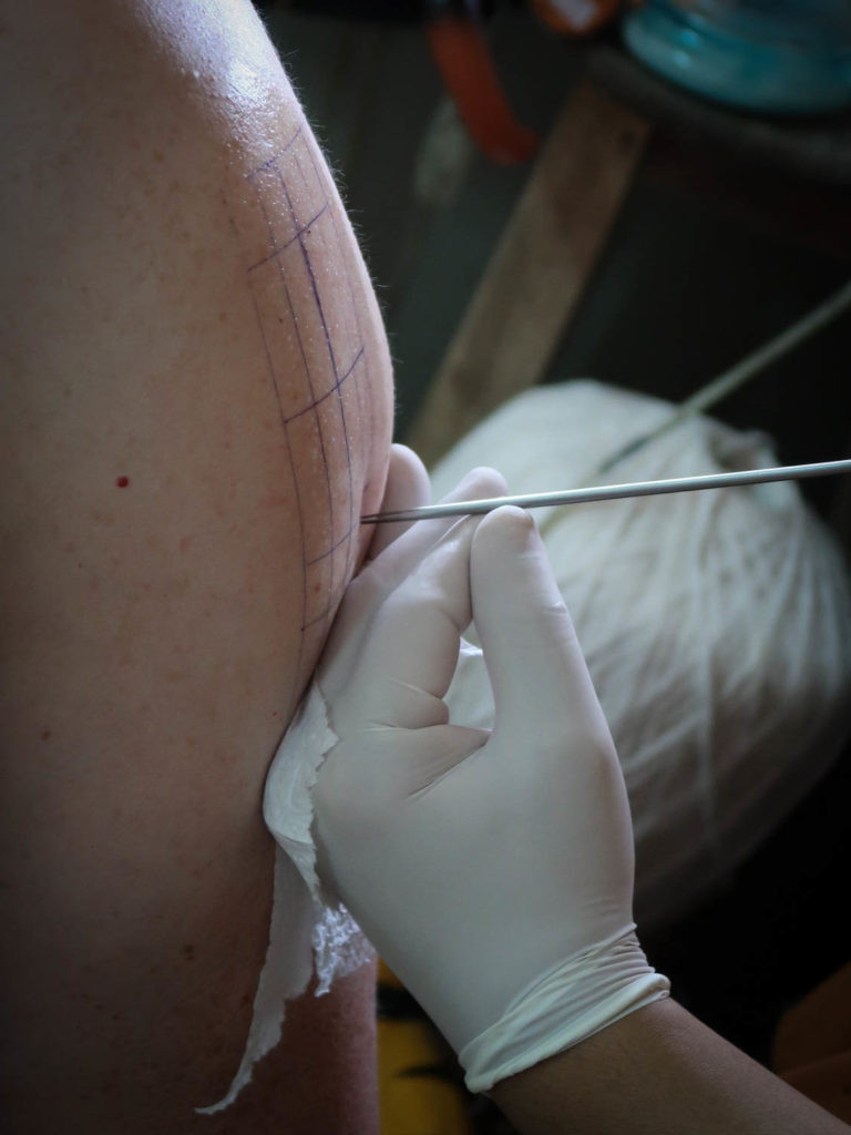 Sak Yant Tattoo in Progress