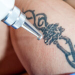 Tattoo removal on arm