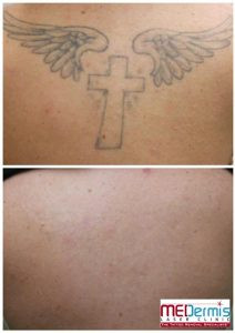 hand poked tattoo equipment