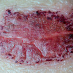 Closeup of a scab
