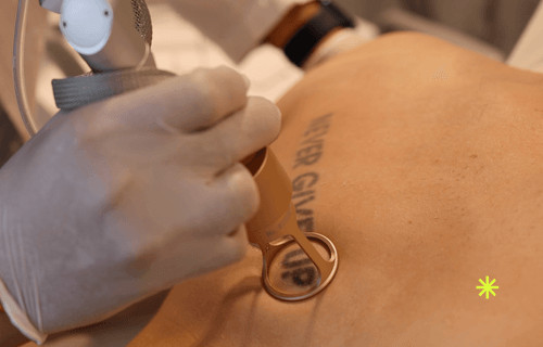 Comparison of tattoo removal methods including laser removal, surgical excision, and dermabrasion.