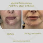 Woman smiling confidently after medical tattooing over a port wine stain.