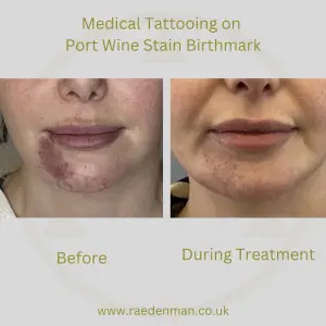 Woman smiling confidently after medical tattooing over a port wine stain.