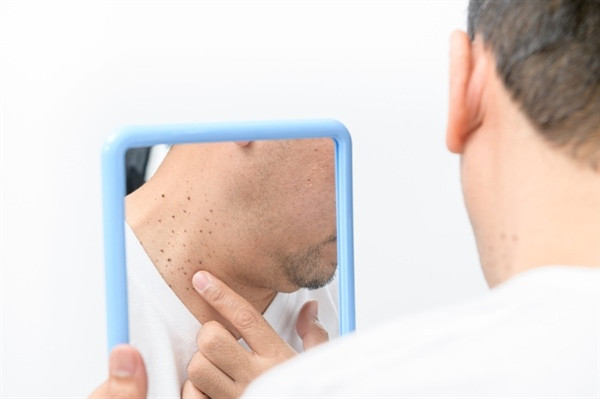 Close-up of a skin tag on a woman's neck