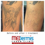 Arm tattoo after one laser session