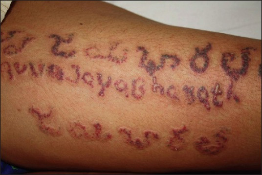 Blistering as a side effect of laser tattoo removal