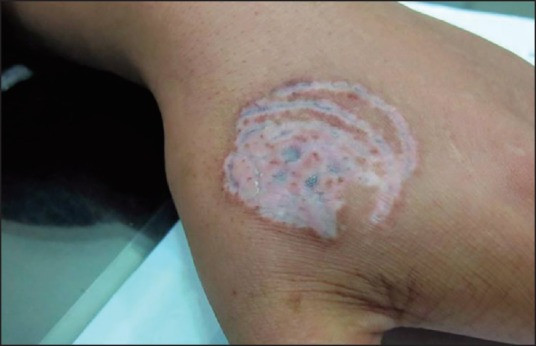 Hyperpigmentation after laser tattoo removal
