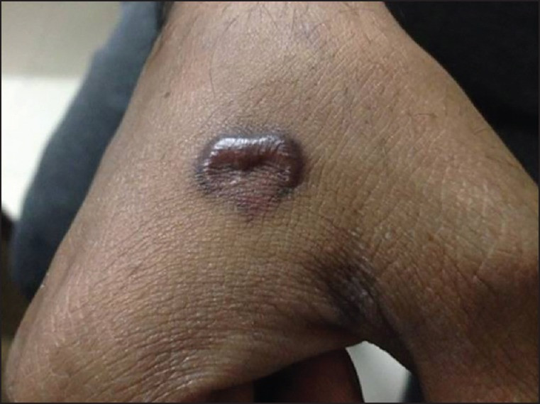 Scarring after laser tattoo removal
