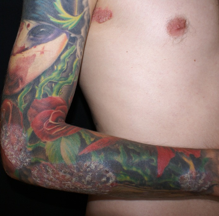 Psoriatic lesions on the tattooed skin