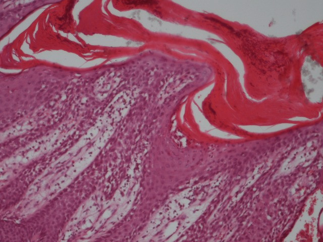 Histopathological exam - Munro's microabscesses and elongated rete ridges