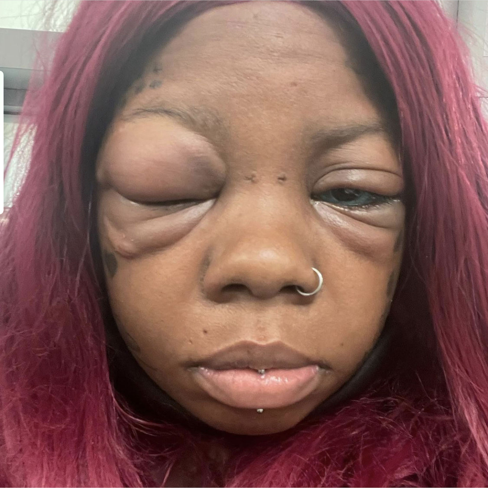 Swollen face of Peterson eye tattoo