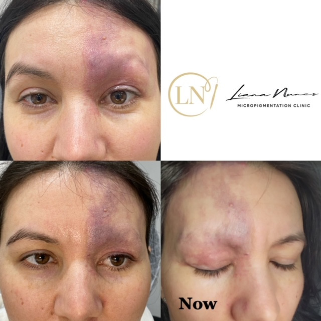 Brazilian Medical &amp; Correctional Tattooing Before &amp; After