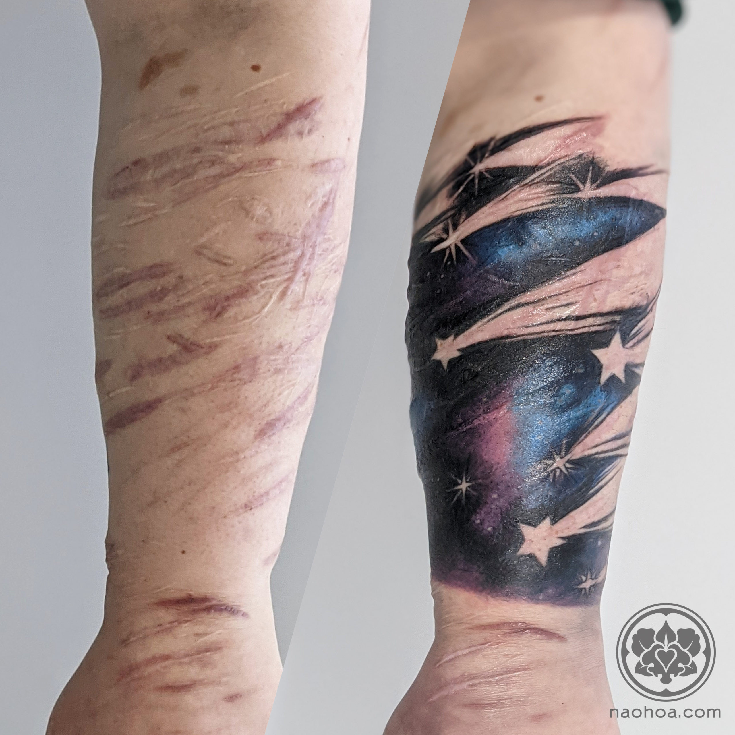 Floral Tattoo Over Scars