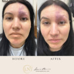 Brazilian Camouflage Tattooing for Port Wine Stain: ONLY 1 session