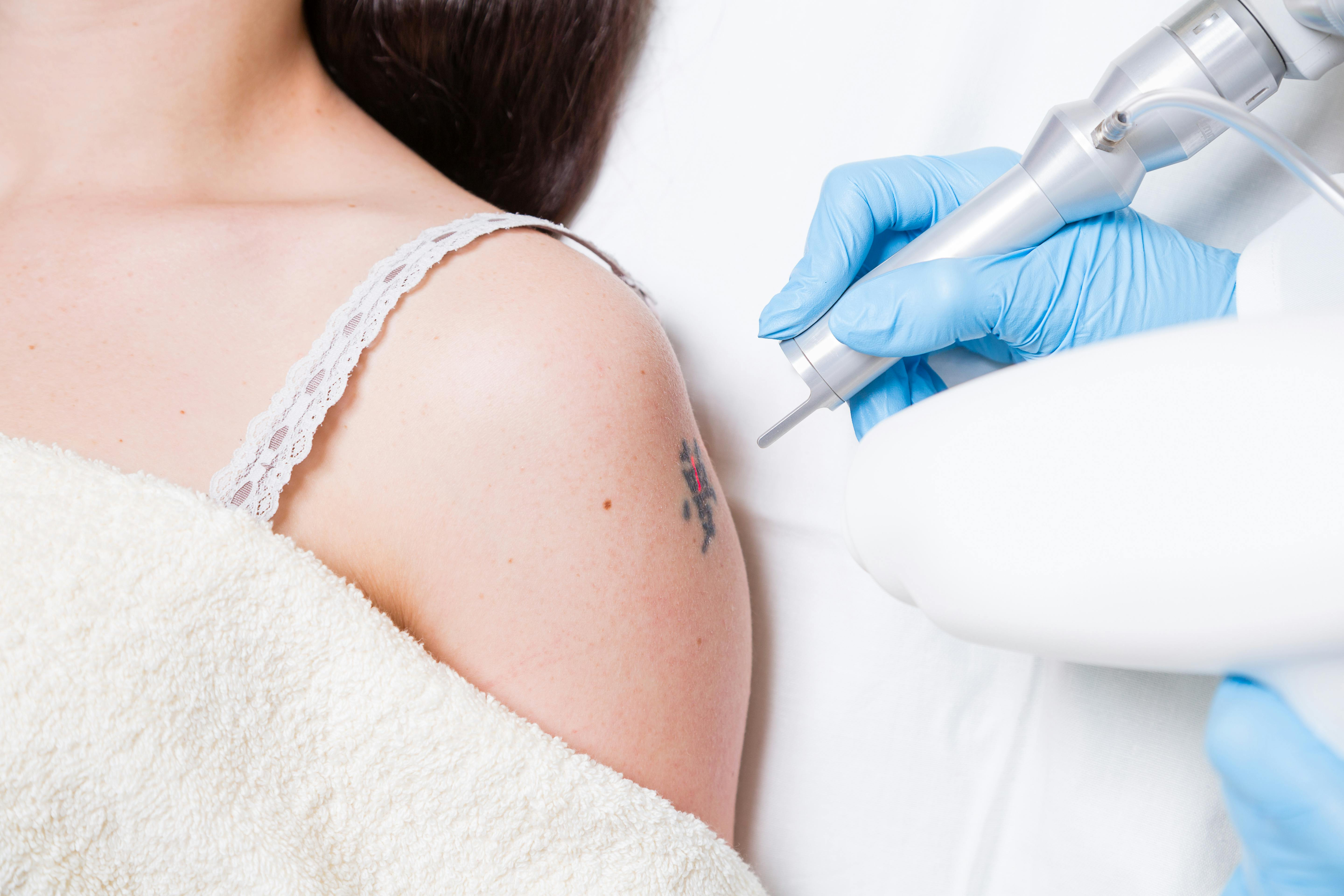 Woman undergoing tattoo removal