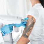 Laser tattoo removal process