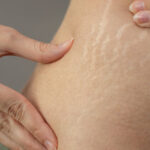 Stretch marks on skin