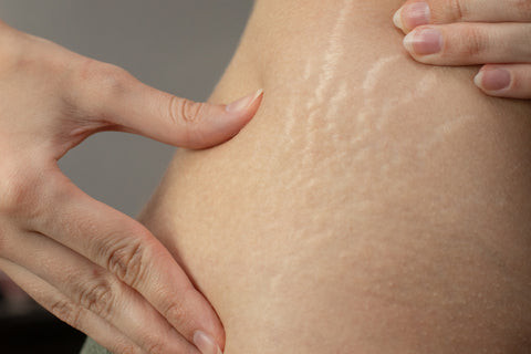 Stretch marks on skin