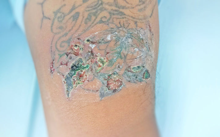 Itchy Tattoo