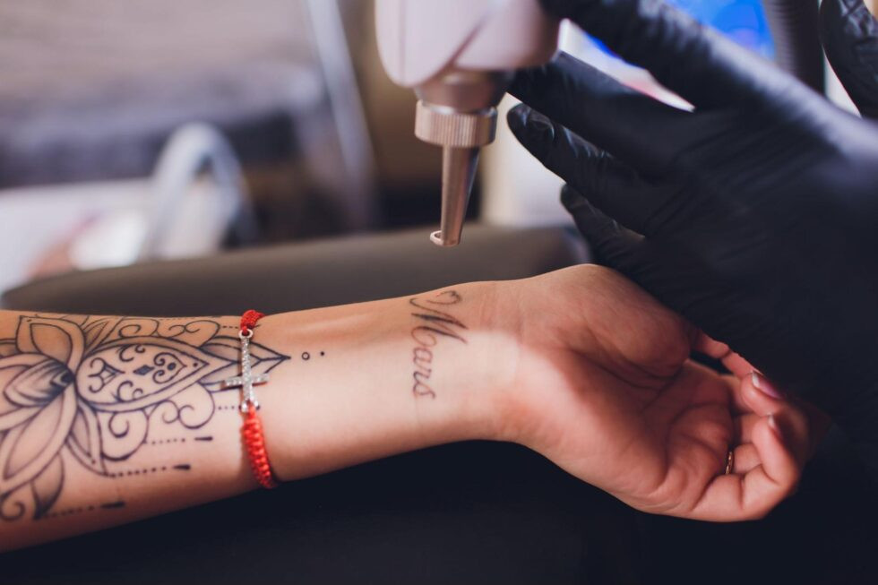 Laser tattoo removal in progress, using advanced technology for safe ink removal.