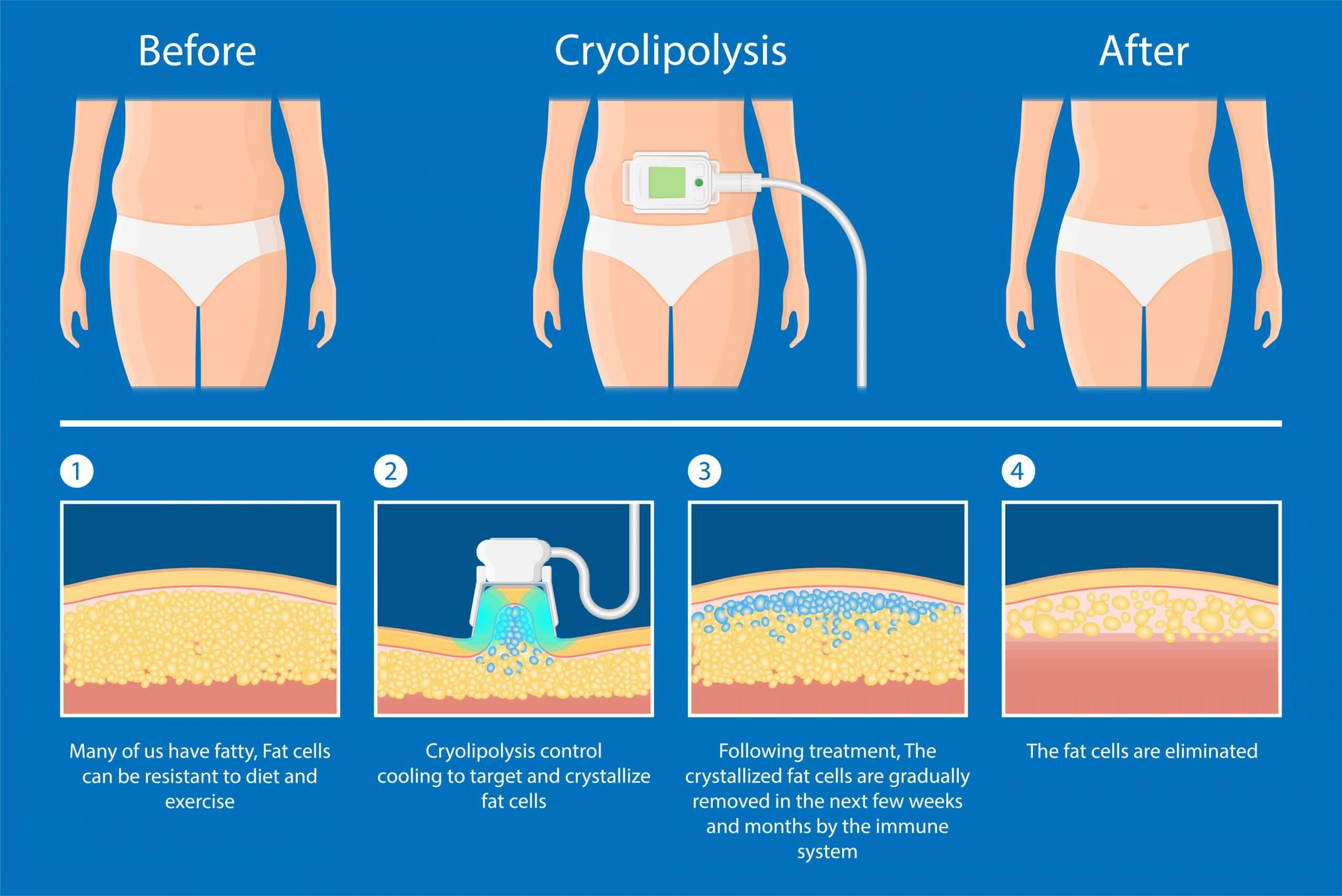 coolsculpting cosmetic laser technician process to remove fat
